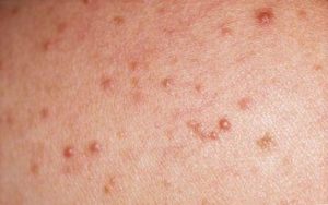 blog over mallorca acne. wat is het en hoe kom je er aan?